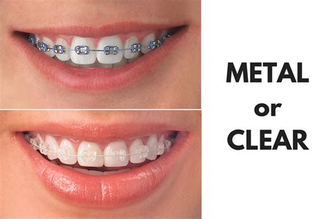 metal braces with clear brackets|metal braces vs clear aligners.